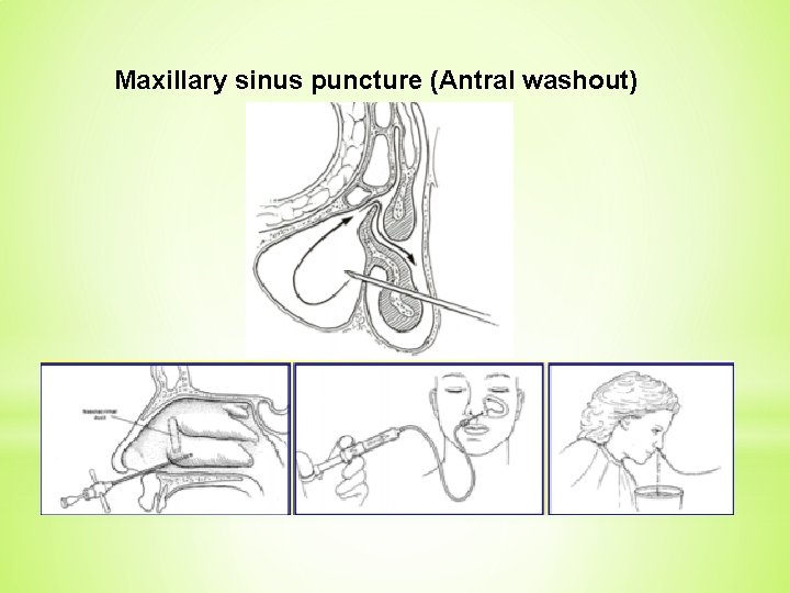 Maxillary sinus puncture (Antral washout) 