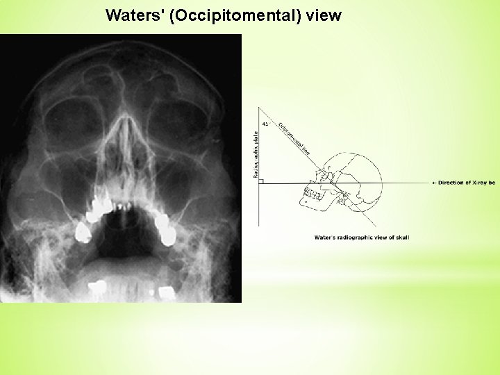 Waters' (Occipitomental) view 