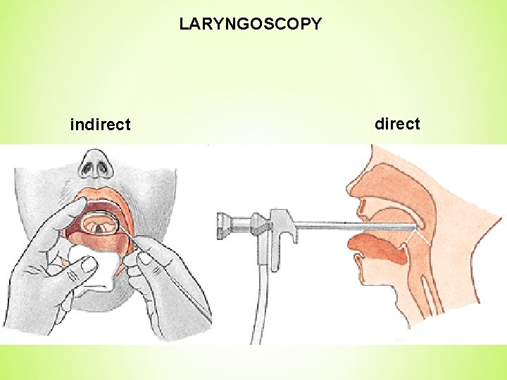 LARYNGOSCOPY indirect 