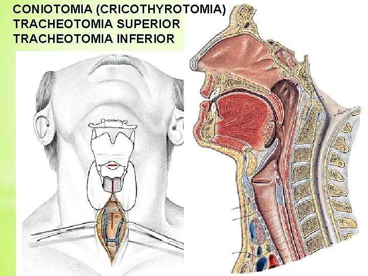 CONIOTOMIA (CRICOTHYROTOMIA) TRACHEOTOMIA SUPERIOR TRACHEOTOMIA INFERIOR 