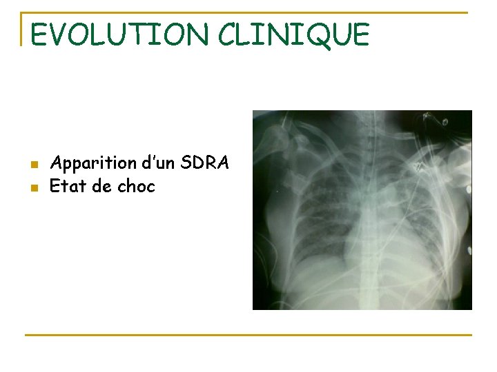 EVOLUTION CLINIQUE n n Apparition d’un SDRA Etat de choc 