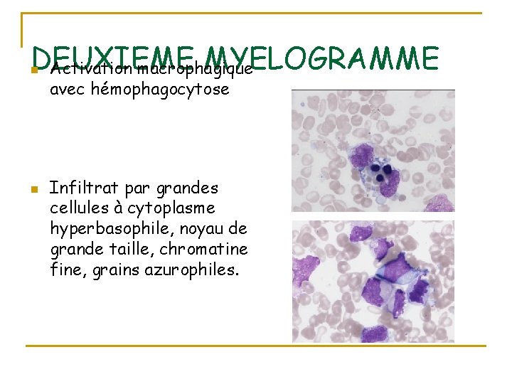 DEUXIEME MYELOGRAMME Activation macrophagique n n avec hémophagocytose Infiltrat par grandes cellules à cytoplasme