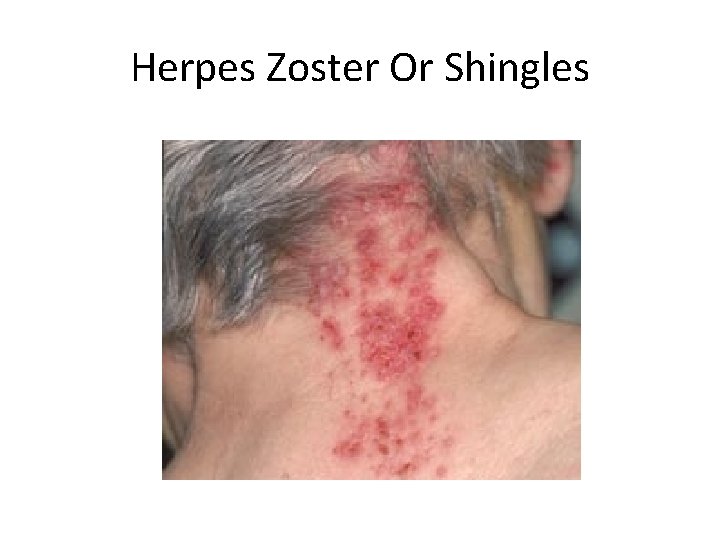 Herpes Zoster Or Shingles 