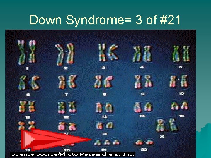 Down Syndrome= 3 of #21 