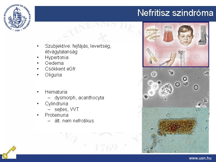 Nefritisz szindróma • • Szubjektíve: fejfájás, levertség, étvágytalanság Hypertonia Oedema Csökkent e. Gfr Oliguria