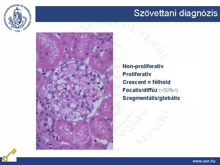 Szövettani diagnózis Non-proliferatív Proliferatív Crescent = félhold Focalis/diffúz (<50%<) Szegmentális/globális 