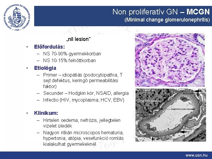 Non proliferatív GN – MCGN (Minimal change glomerulonephritis) „nil lesion” • Előfordulás: – NS