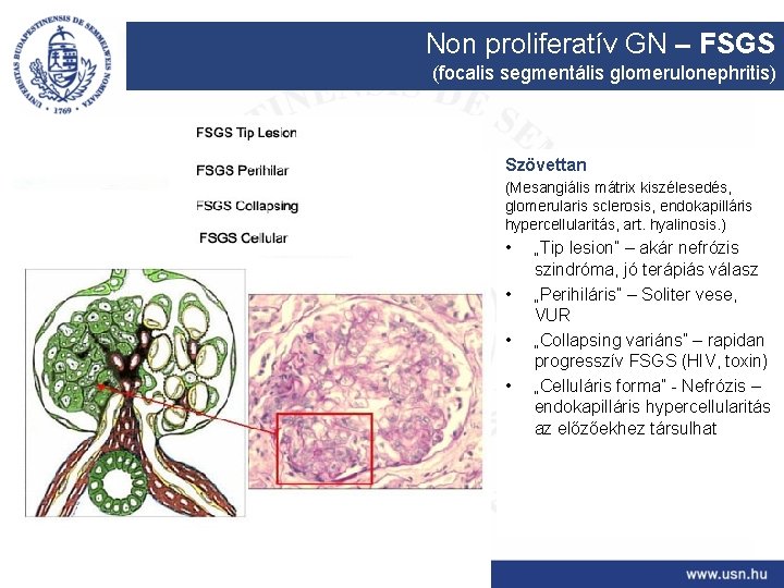 Non proliferatív GN – FSGS (focalis segmentális glomerulonephritis) Szövettan (Mesangiális mátrix kiszélesedés, glomerularis sclerosis,