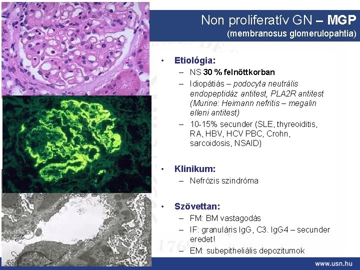 Non proliferatív GN – MGP (membranosus glomerulopahtia) • Etiológia: – NS 30 % felnőttkorban