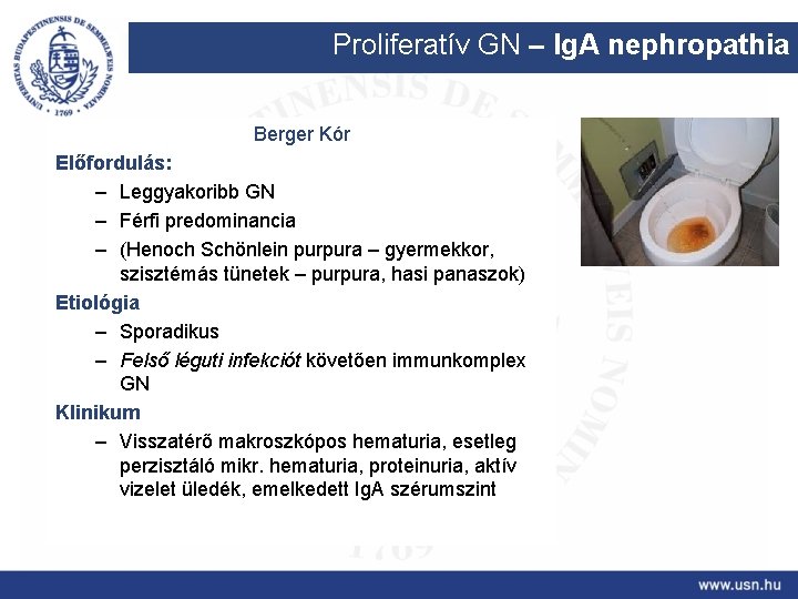 Proliferatív GN – Ig. A nephropathia Berger Kór Előfordulás: – Leggyakoribb GN – Férfi