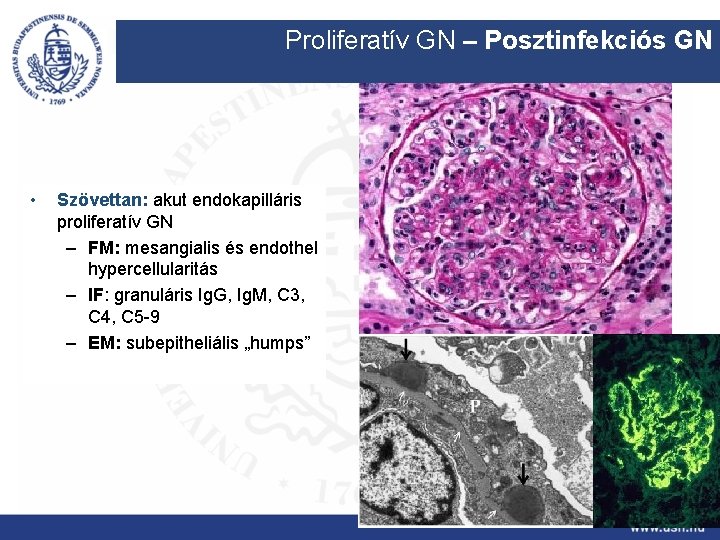Proliferatív GN – Posztinfekciós GN • Szövettan: akut endokapilláris proliferatív GN – FM: mesangialis