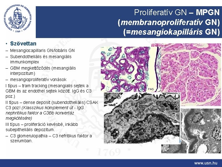Proliferatív GN – MPGN (membranoproliferatív GN) (=mesangiokapilláris GN) • Szövettan – Mesangiocapillaris GN/lobáris GN