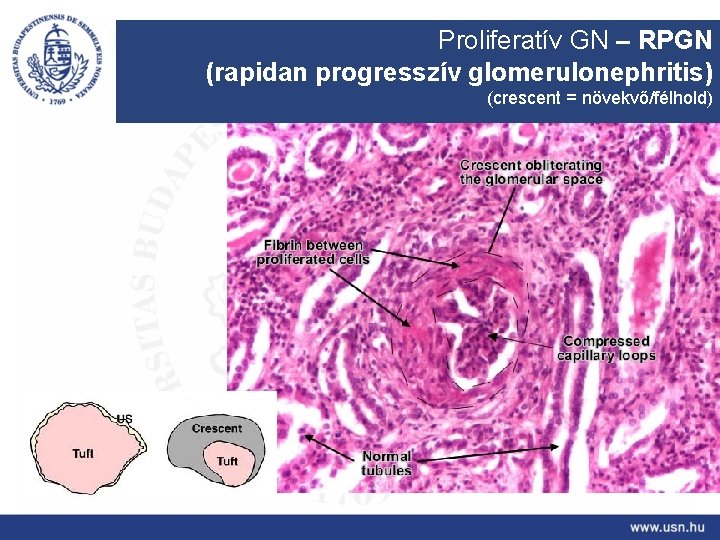 Proliferatív GN – RPGN (rapidan progresszív glomerulonephritis) (crescent = növekvő/félhold) 