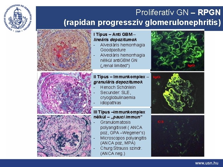 Proliferatív GN – RPGN (rapidan progresszív glomerulonephritis) I Típus – Anti GBM – lineáris