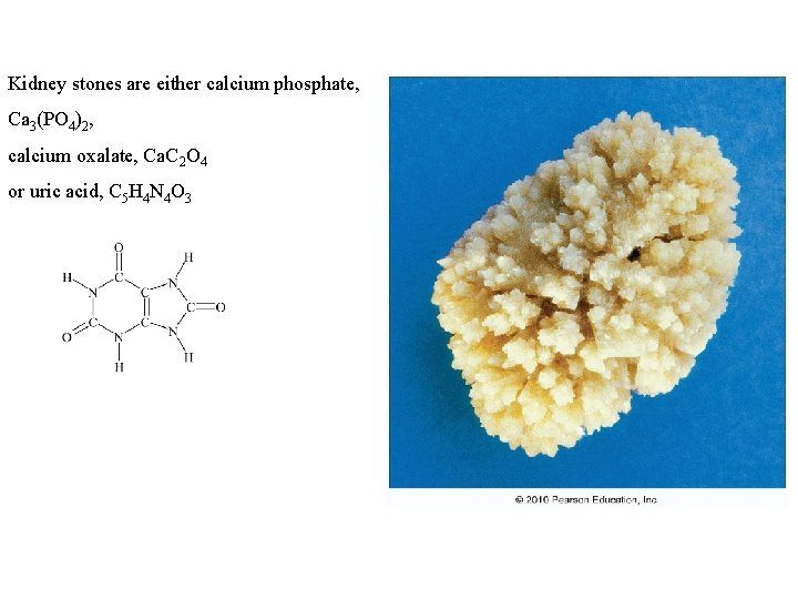 Kidney stones are either calcium phosphate, Ca 3(PO 4)2, calcium oxalate, Ca. C 2