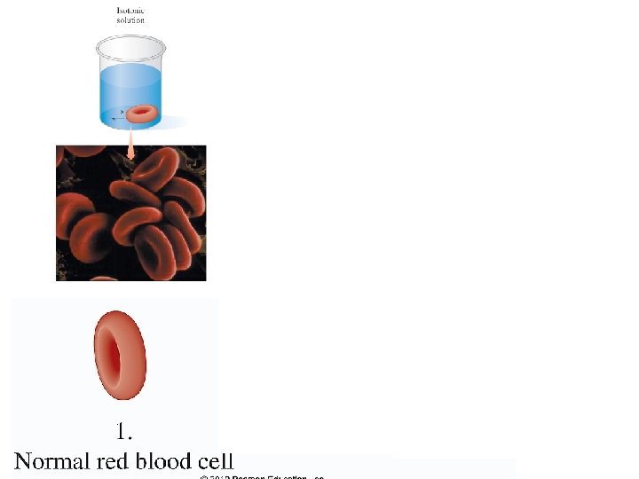 A hypotonic solution has a lower osmotic pressure than red blood cells (RBCs) containes