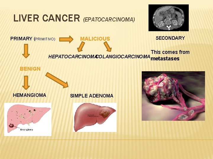 LIVER CANCER (EPATOCARCINOMA) PRIMARY (PRIMITIVO) MALICIOUS SECONDARY This comes from HEPATOCARCINOMACOLANGIOCARCINOMA metastases BENIGN HEMANGIOMA