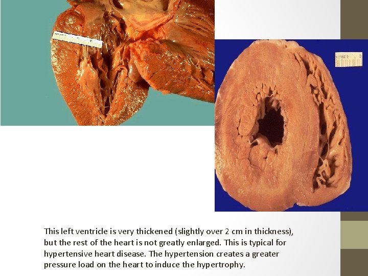 This left ventricle is very thickened (slightly over 2 cm in thickness), but the