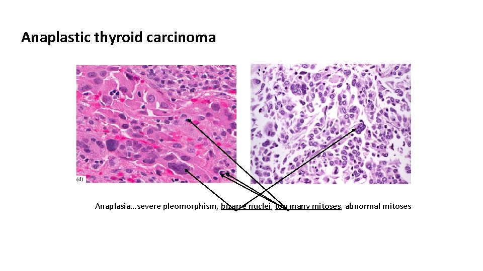 Anaplastic thyroid carcinoma Anaplasia…severe pleomorphism, bizarre nuclei, too many mitoses, abnormal mitoses 