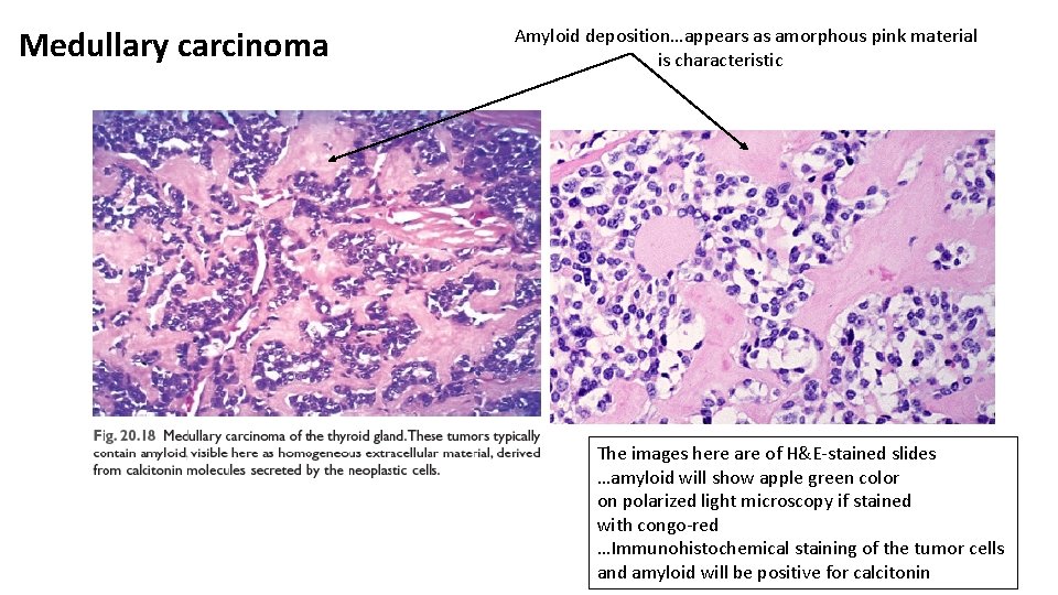 Medullary carcinoma Amyloid deposition…appears as amorphous pink material is characteristic The images here are