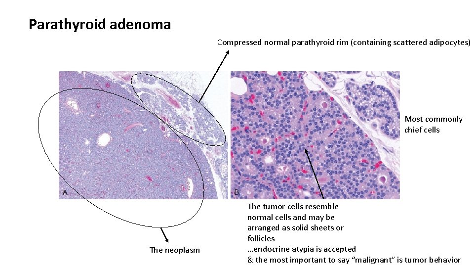 Parathyroid adenoma Compressed normal parathyroid rim (containing scattered adipocytes) Most commonly chief cells The