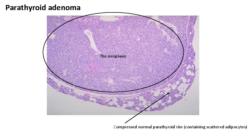 Parathyroid adenoma The neoplasm Compressed normal parathyroid rim (containing scattered adipocytes) 