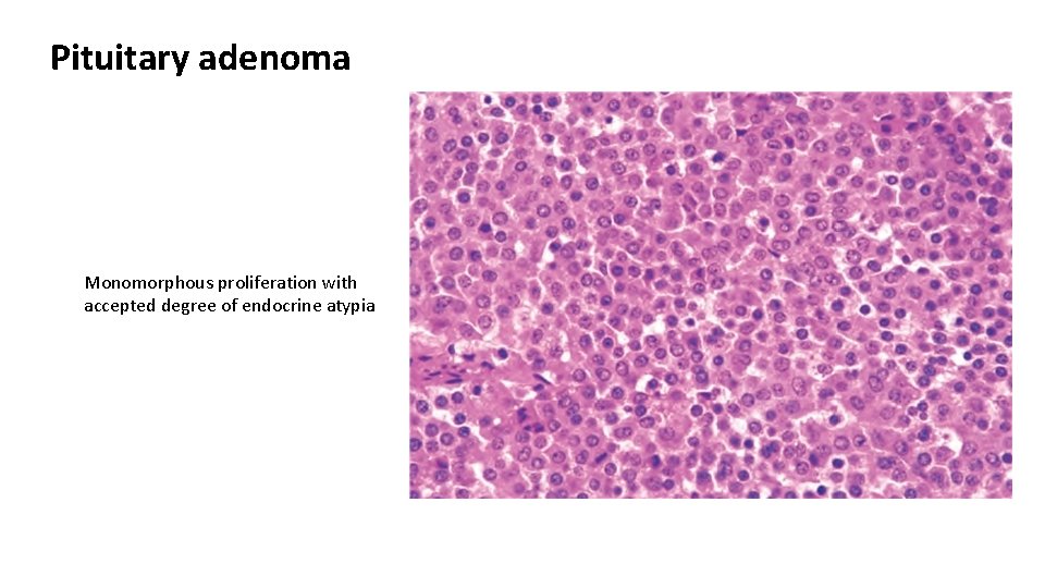 Pituitary adenoma Monomorphous proliferation with accepted degree of endocrine atypia 