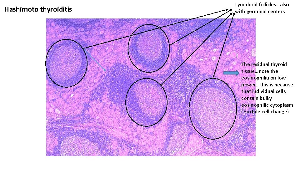 Hashimoto thyroiditis Lymphoid follicles…also with germinal centers The residual thyroid tissue…note the eosinophilia on