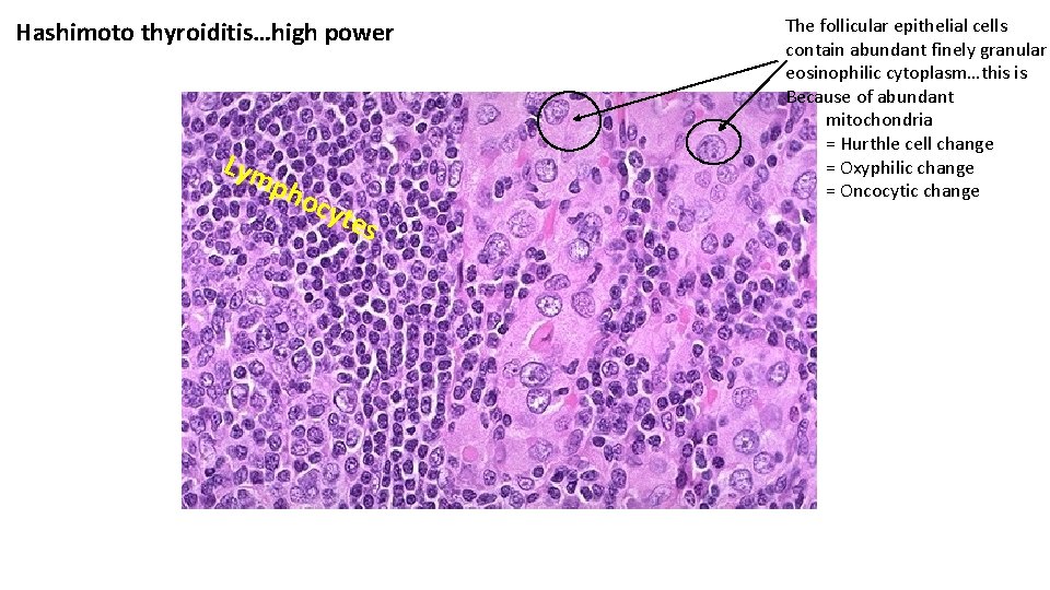 Hashimoto thyroiditis…high power Lym pho cyt es The follicular epithelial cells contain abundant finely