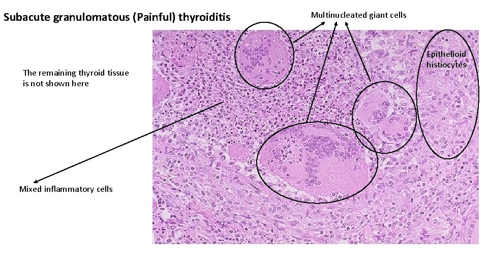 Subacute granulomatous (Painful) thyroiditis The remaining thyroid tissue is not shown here Mixed inflammatory