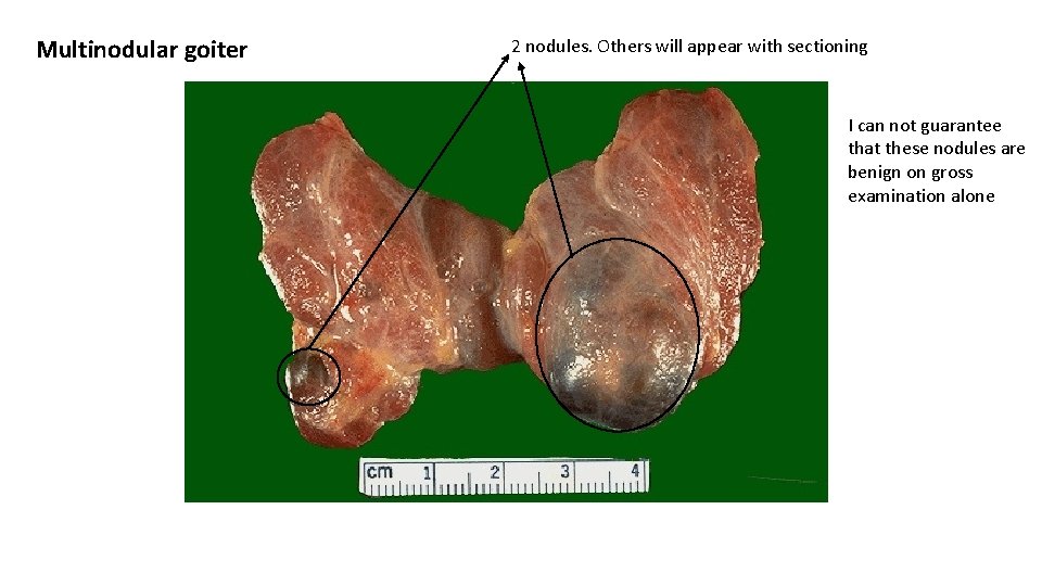 Multinodular goiter 2 nodules. Others will appear with sectioning I can not guarantee that