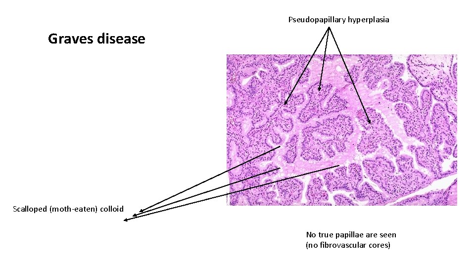 Pseudopapillary hyperplasia Graves disease Scalloped (moth-eaten) colloid No true papillae are seen (no fibrovascular