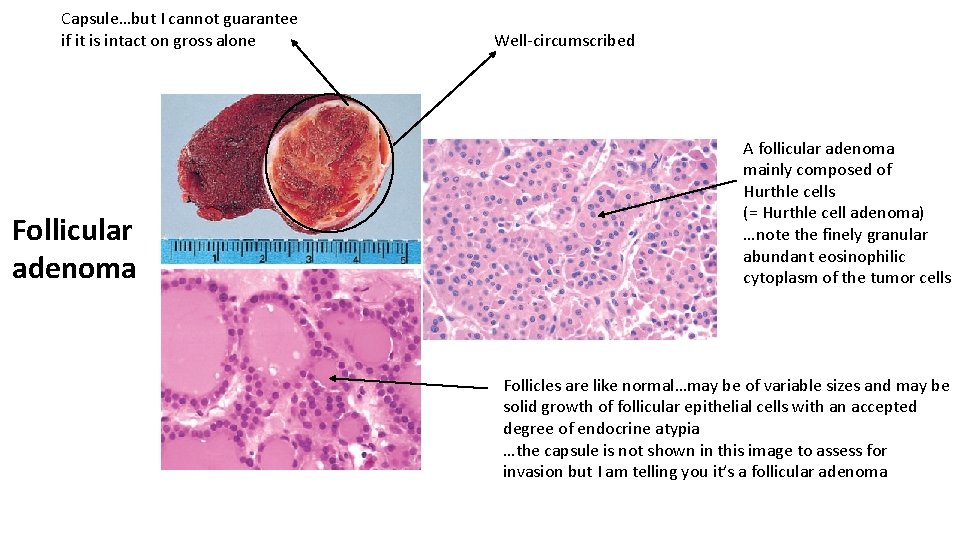 Capsule…but I cannot guarantee if it is intact on gross alone Follicular adenoma Well-circumscribed