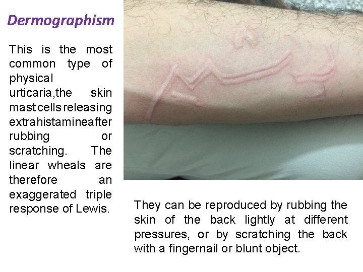 Dermographism This is the most common type of physical urticaria, the skin mast cells