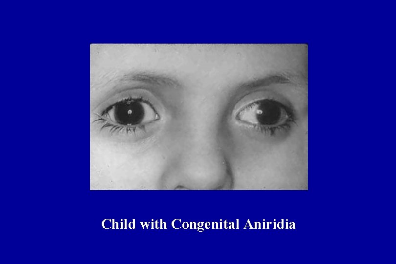 Child with Congenital Aniridia 
