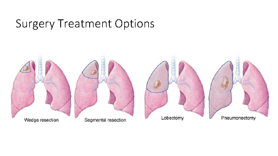 Surgery Treatment Options 