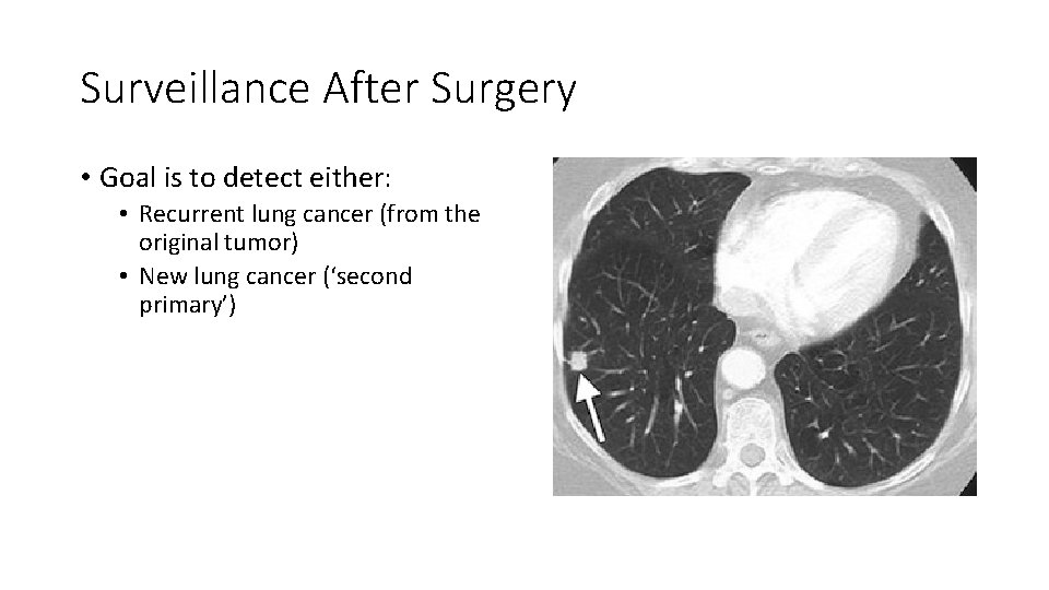 Surveillance After Surgery • Goal is to detect either: • Recurrent lung cancer (from