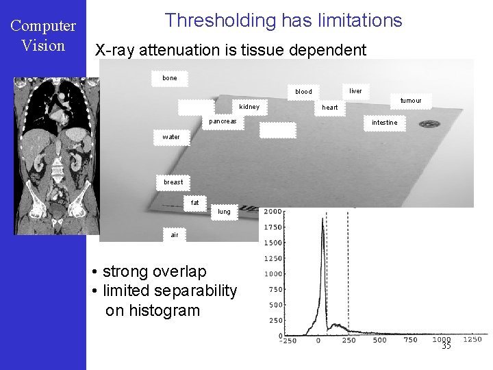 Computer Vision Thresholding has limitations X-ray attenuation is tissue dependent bone liver blood kidney