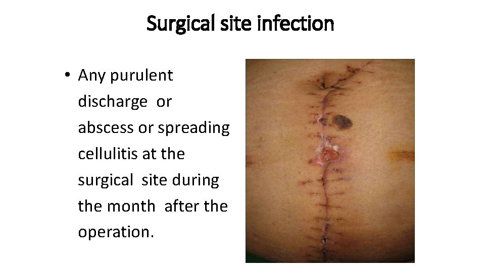 Surgical site infection • Any purulent discharge or abscess or spreading cellulitis at the