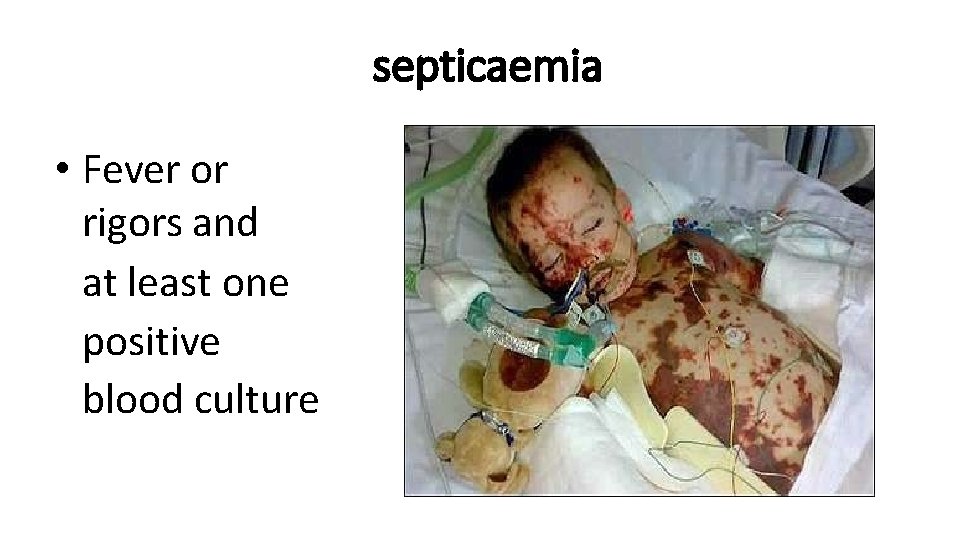 septicaemia • Fever or rigors and at least one positive blood culture 