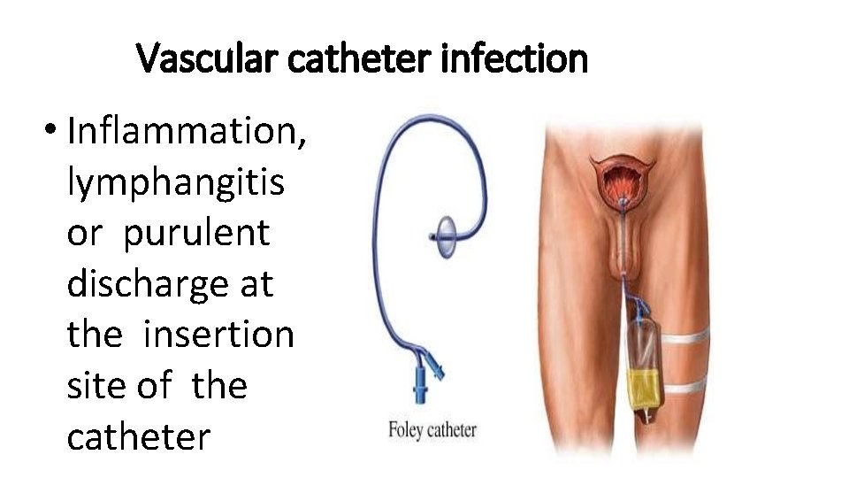 Vascular catheter infection • Inflammation, lymphangitis or purulent discharge at the insertion site of