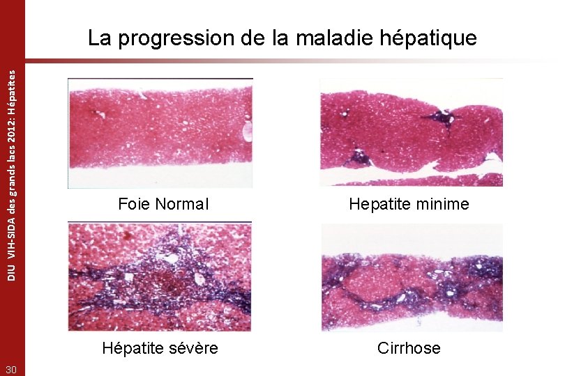 DIU VIH-SIDA des grands lacs 2012: Hépatites La progression de la maladie hépatique 30