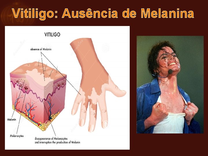 Vitiligo: Ausência de Melanina 