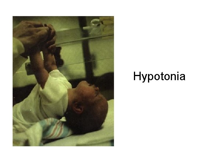 Hypotonia 