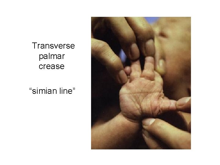 Transverse palmar crease “simian line” 