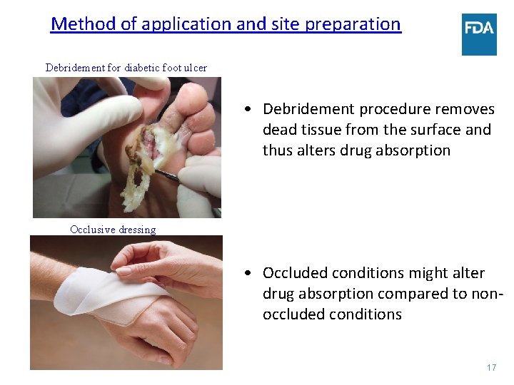 Method of application and site preparation Debridement for diabetic foot ulcer • Debridement procedure