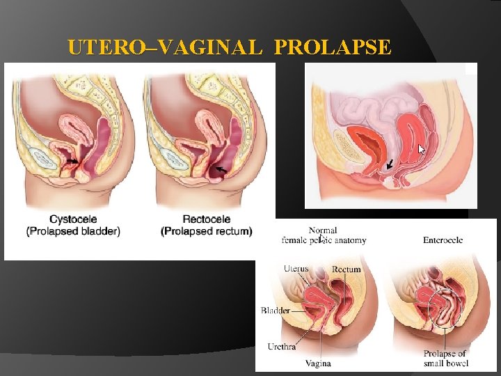 UTERO–VAGINAL PROLAPSE 