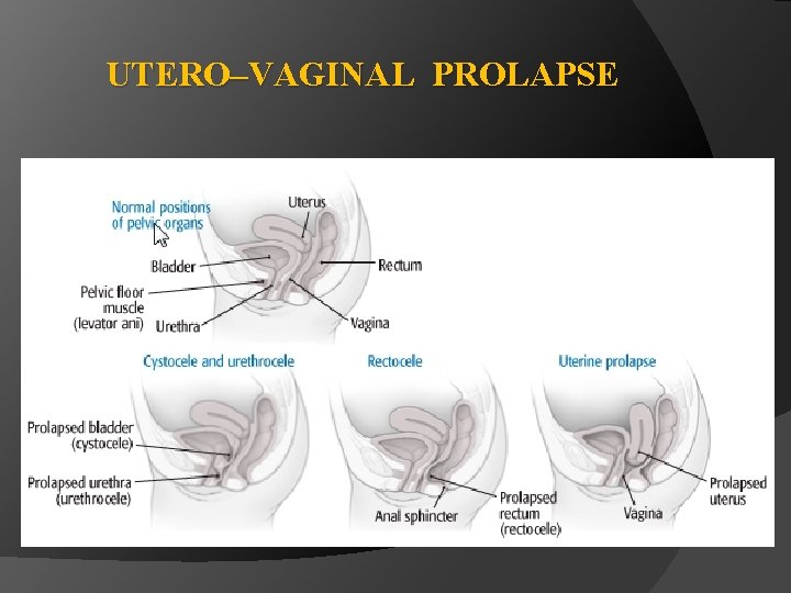 UTERO–VAGINAL PROLAPSE 