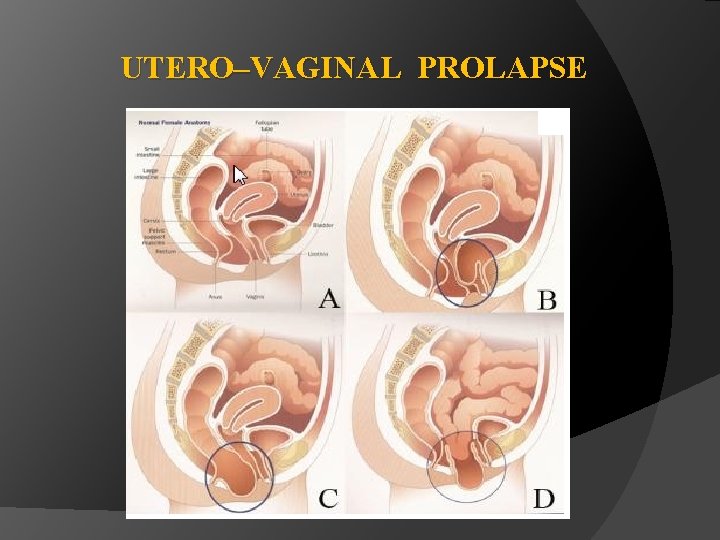 UTERO–VAGINAL PROLAPSE 