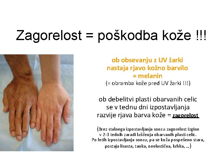 Zagorelost = poškodba kože !!! ob obsevanju z UV žarki nastaja rjavo kožno barvilo